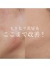 【乾燥肌・かゆみ・ヒリヒリ】アンストレス￥22,000→ ￥11,000