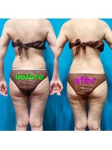 ラ シルク(La silk)/ハイパーナイフ全身