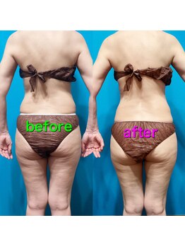 ラ シルク(La silk)/ハイパーナイフ全身