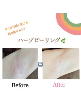 アイリス(AIRIS)/フェイシャル/毛穴ケア/美白