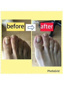 リゼラアンドコー 宇都宮店/巻き爪/肥厚爪、ネイルケア