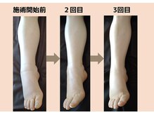 そらのいえ/足のむくみビフォーアフター
