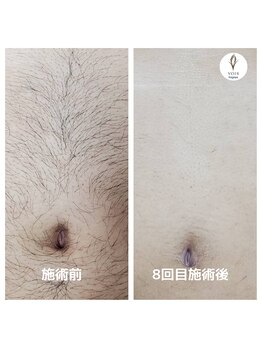 ヴォアール 名古屋店(VOIR)/お腹脱毛