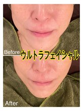 ロゼッティ(ROSETTY)/ウルトラフェイシャル&デコルテ