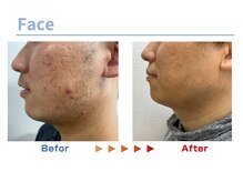 キングスサロン 熊本/メンズ髭脱毛ビフォーアフター