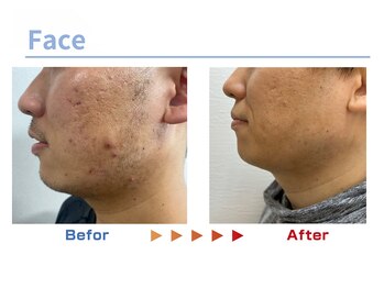 キングスサロン 熊本/メンズ髭脱毛ビフォーアフター