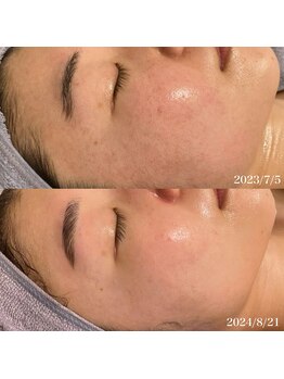 リリアス(RILLIAS)/毛穴ケア