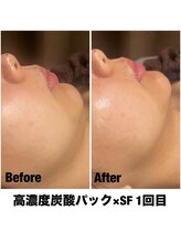 Sスタイルスタジオ 福岡天神/炭酸パック×サーマル1回目