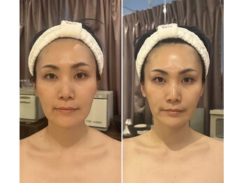 リフリコ/【REVI陶肌トリートメント】