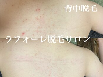 ラフォーレ 岸和田店/全身脱毛(お好きな箇所が選べる)