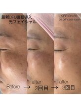 プリンセスローズ 焼津店(Princess Rose)/光フェイシャル