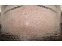 アンドユー ヨコハマ(&U Yokohama)/クリスティーナ施術1回後