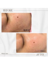 ホワイトラボ 梅田(White labo)/【施術例】ハイドロフェイシャル