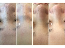 ビューティーマックス(Beauty Max)/フェイシャルbefore→after 1回