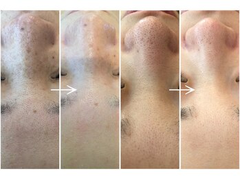 ビューティーマックス(Beauty Max)/フェイシャルbefore→after 1回