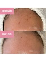 リシェル(Richelle)/ 【GREENPEELスペシャル1day】