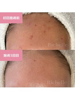 リシェル(Richelle)/ 【GREENPEELスペシャル1day】