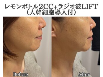 イーラボ 池袋店(e-LABO)/レモンボトル+ラジオ波Lift