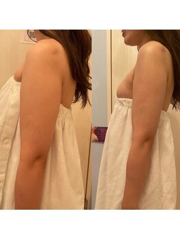 メゾン アンジュ(Maison Ange)/二の腕1回目/レモンボトル