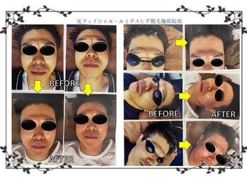 磨凛/脱毛&光フェイシャル