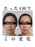 【小顔になりたい】小顔頭蓋骨矯正＋美肌美顔器4回モニター￥39600→￥22000