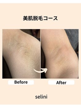 ミレア(Mirea)/ワキ脱毛なら施術は10分☆
