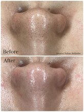 アンティミテ(Intimite)/毛穴洗浄1回の変化