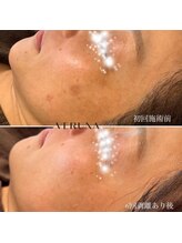 リズ ボーテ/肌育ハーブピーリング しみシワ