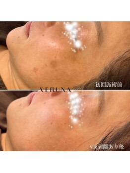 リズ ボーテ/肌育ハーブピーリング しみシワ