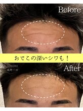 ココロ(COCORO)/おでこのシワも