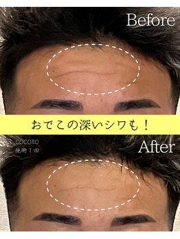 ココロ(COCORO)/おでこのシワも