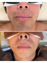 リサ(LiSA)/Q.髭脱毛は痛いですか？