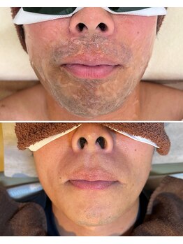 リサ(LiSA)/Q.髭脱毛は痛いですか?