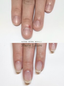 マリーロール 梅田店(Marie Laure)/自爪育成/深爪矯正/ネイルケア