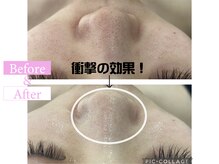 カンナムビューティー/ハーブピーリング圧倒的毛穴レス