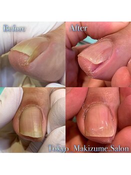 巻き爪補正店 西宮北口店/巻き爪