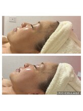 BBC 田園調布/小顔コルギ効果