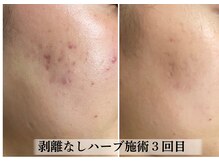 ラビエス(LAVIES)/【30代】ブライダル前になんとか