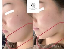 【プラズマ×脂肪分解美容液導入】引き締まったフェイスラインに