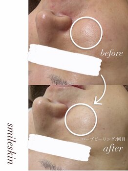 スマイルネイル(SMILE NAIL)/ハーブピーリング