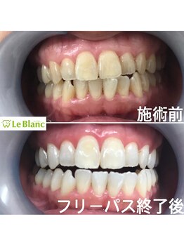 ルブラン 奈良店(Le Blanc)/艶もでるホワイトニング！