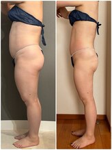 エミニー バイ エルズ(Eminy by L★s)/40代　セルゼロ全身　24回