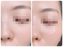 トータルビューティ ノイド(Noid)/毛穴洗浄　お試し全顔