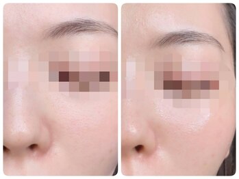 トータルビューティ ノイド(Noid)/毛穴洗浄　お試し全顔