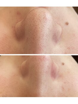 ポアレ(POARE)/毛穴の変化！