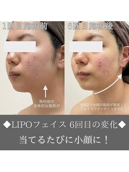 ナンバーファイブクリニカルサロン 札幌店(No.5)/BeforeAfter/脂肪減少&小顔