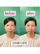 ゲンキ鍼灸整骨院 かどの(Genki鍼灸整骨院)/ほうれい線たるみのケアに美容鍼