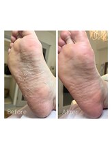 トウキョウビューティーラボ 表参道店(TOKYO BEAUTY LABO.)/１回で劇的に足裏チェンジ