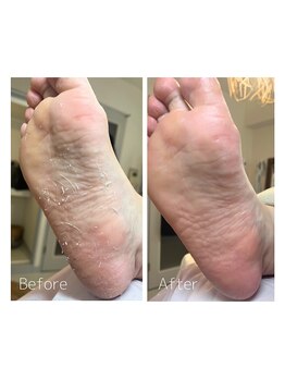 トウキョウビューティーラボ 表参道店(TOKYO BEAUTY LABO.)/１回で劇的に足裏チェンジ