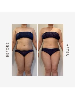 ラグレ(LUXRE)/脂肪冷却モニター（30代）